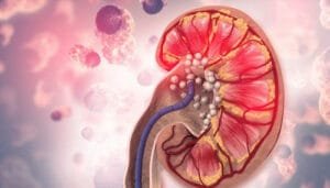 Preventing Kidney Stones: Lifestyle Changes for Better Health