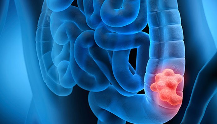 5 Common Colon Cancer Signs People Often Overlook